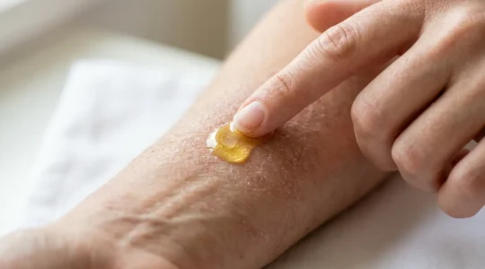 Main appliquant délicatement de l'huile de CBD sur une peau avec eczéma atopique en cours d'apaisement
